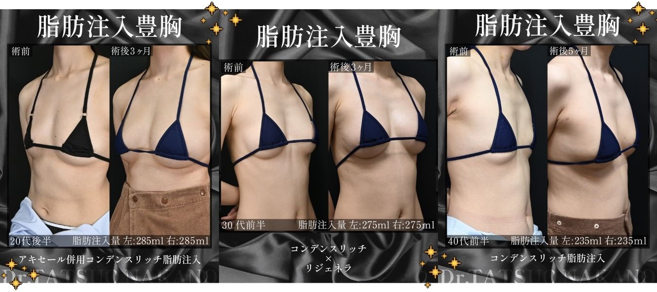 2. 脂肪注入豊胸